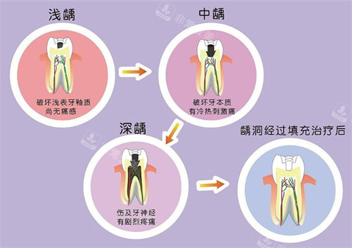 不同程度的深齲