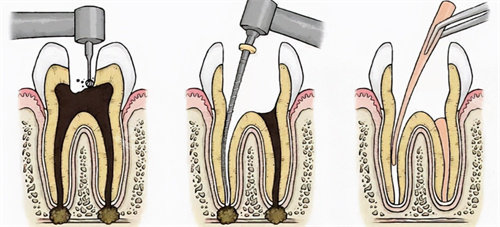 深龋千万别补牙去做根管治疗？