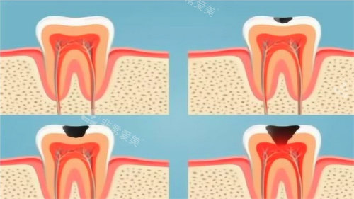 深龋千万别补牙去做根管治疗？