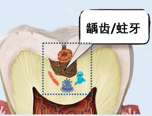 深齲圖