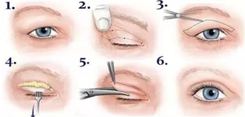 全切双眼皮图