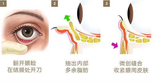 內(nèi)切法圖片 內(nèi)切法圖片