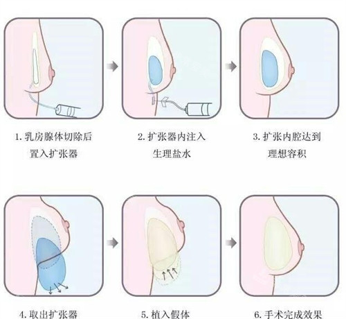 讲述乳房大小不对称怎么办？