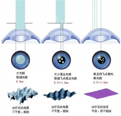 四眼救星:全飞秒近视术能管一辈子吗？术后会干眼吗?