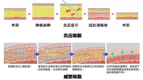 負壓式和威塑吸脂圖