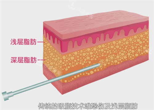 吸脂手术的危害和副作用有哪些？