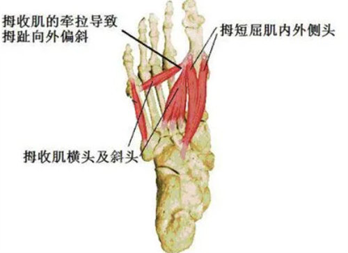 大脚趾拇外翻的危害有哪些？