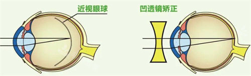 近视手术有必要做吗？