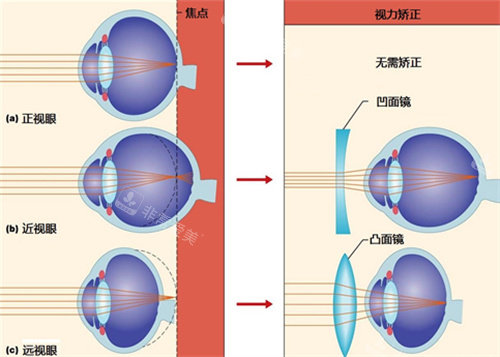 正常眼和近视眼