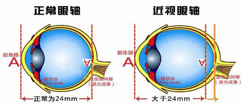 正常眼軸和近視眼軸圖