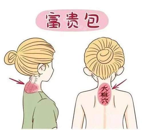 富贵包示意图 富贵包示意图