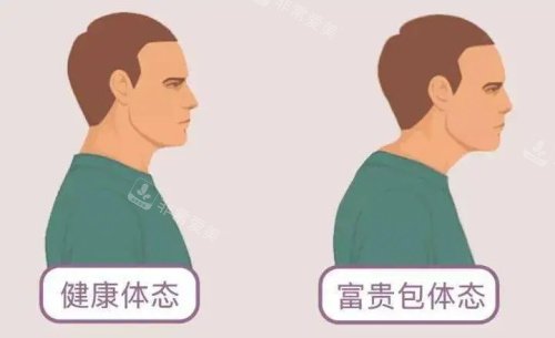 富贵包示意图 富贵包示意图