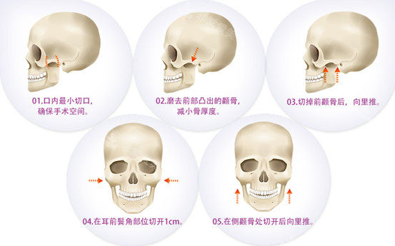 削颧骨手术图片