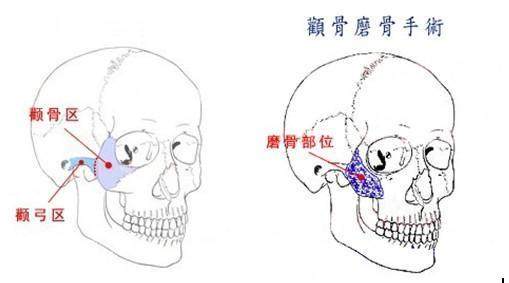 顴骨磨骨手術(shù)圖片 顴骨磨骨手術(shù)圖片