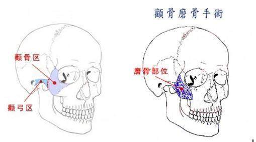 颧骨磨骨手术图片