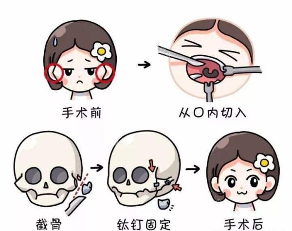 口腔內(nèi)切法圖片 口腔內(nèi)切法圖片