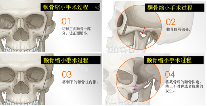 颧骨缩小手术图片