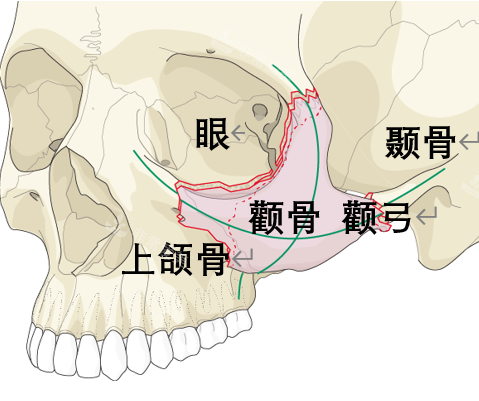 顴骨位置圖片 顴骨位置圖片