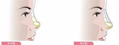 隆鼻前后动画图 隆鼻前后动画图
