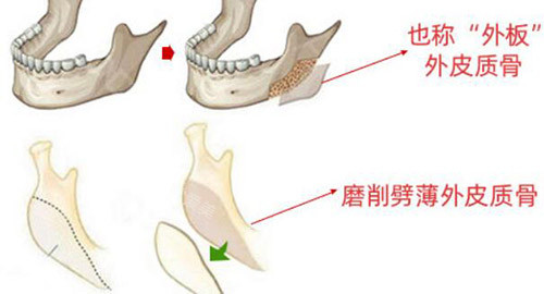 下颌角整形手术方法有哪些，讲述不同手术方法！