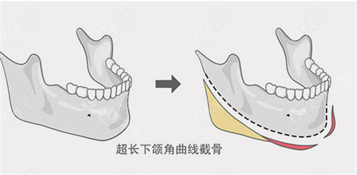 超长下颌角图片