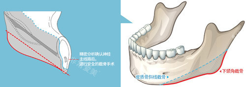 下颌角切除图片