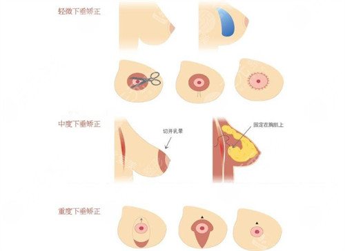 三种胸下垂程度图片