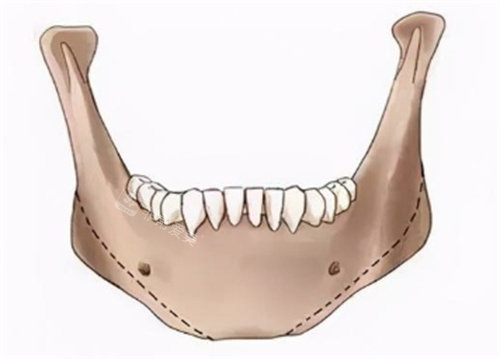 下颌角切多了怎么办？