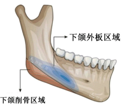 下颌角削骨区域图