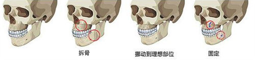 凸嘴手術(shù)過(guò)程圖