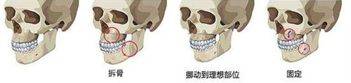 凸嘴手術(shù)過程圖