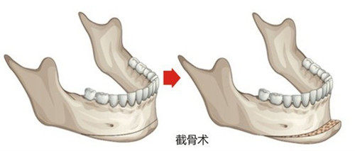 截骨術(shù)圖示