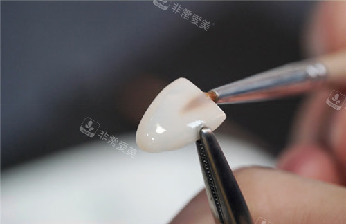 韩国2D牙科贴面图示
