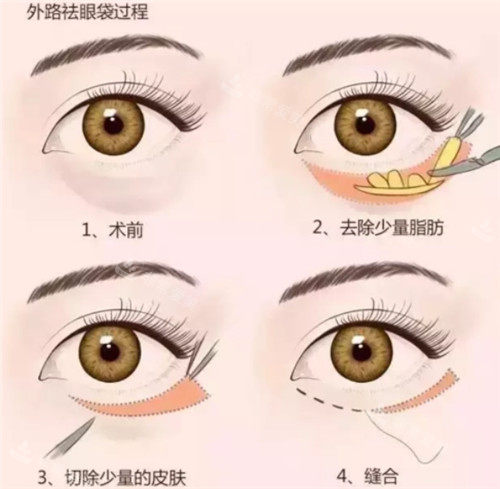 眼袋手術(shù)細(xì)節(jié)圖