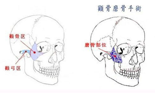 颧骨磨骨手术图片