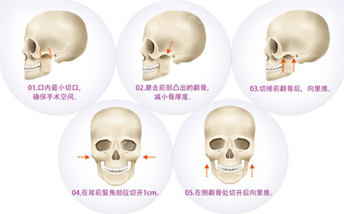 颧骨手术图片