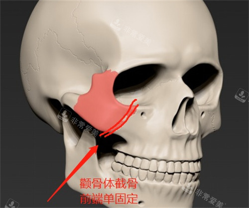 I型颧骨图片