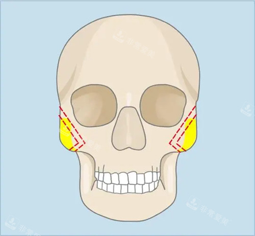 颧骨高做什么手术？该如何选择？