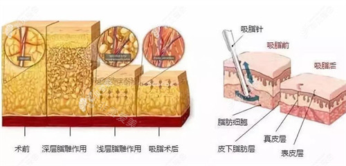 脂肪层图片