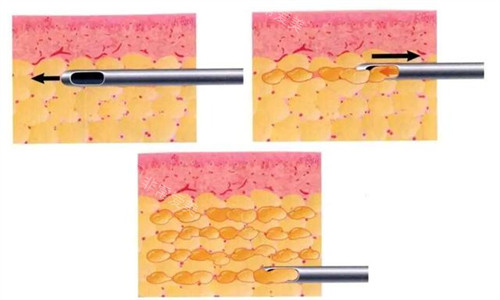 脂肪针图片