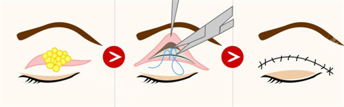 双眼皮缝合过程展示图
