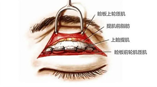 切开双眼皮手术方法图