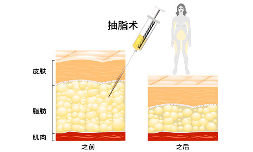 抽脂手术前后脂肪层对比图