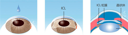 晶体植入手术过程图