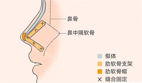 隆鼻手術結構組織展示圖