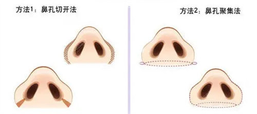 鼻翼整形手術(shù)方式圖
