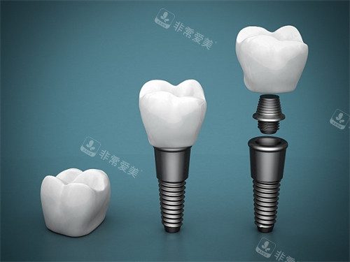 种植牙组成部分