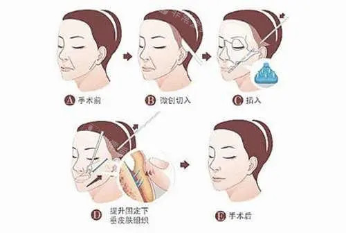 太阳穴凹陷手术图片 太阳穴凹陷手术图片