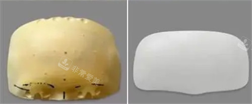 額頭假體圖片 額頭假體圖片