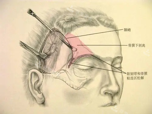 颞部去皱手术方式有哪些？